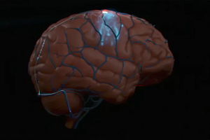 Synchron первой в мире установила человеку чип в мозг