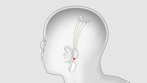 Чип Neuralink позволит стримить музыку прямо в мозг